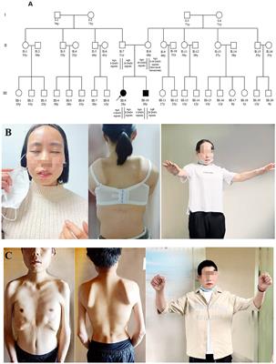 Case report: Identification of facioscapulohumeral muscular dystrophy 1 in two siblings with normal phenotypic parents using optical genome mapping